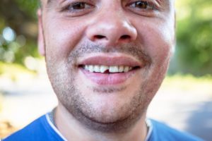 man smiling with a chipped tooth 