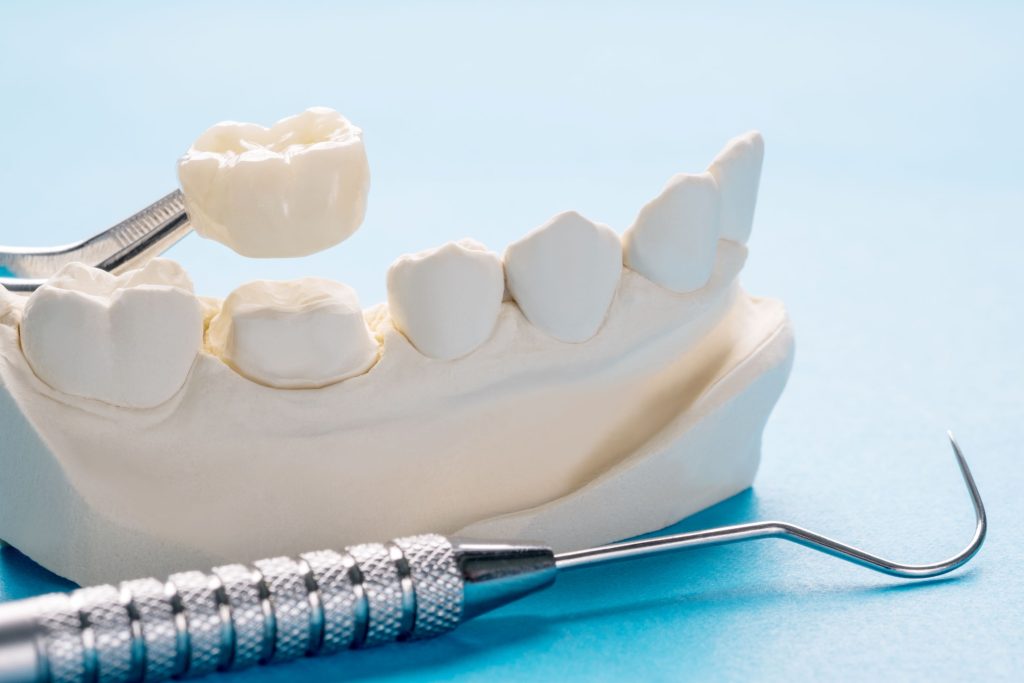 Sample dental crown behind held above model lower arch