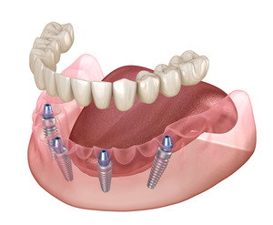 Illustration of prosthesis for All-on-4 being placed in lower jaw