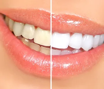 Before and after image of a teeth whitening treatment