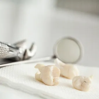 Close-up of teeth after tooth extraction in Vero Beach, FL