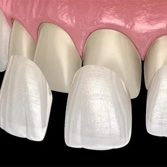 Illustration of veneers being placed over the fronts of teeth