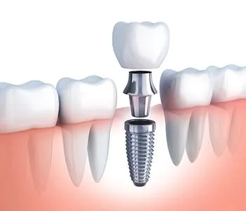 Diagram of how dental implants in Vero Beach work