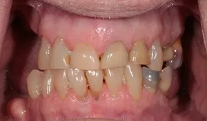 Patient With Damaged Teeth Before Vero Beach Implant Dentures