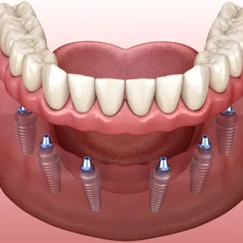 Who’s a Good Candidate for Dentures?