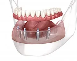 Dentures Aftercare