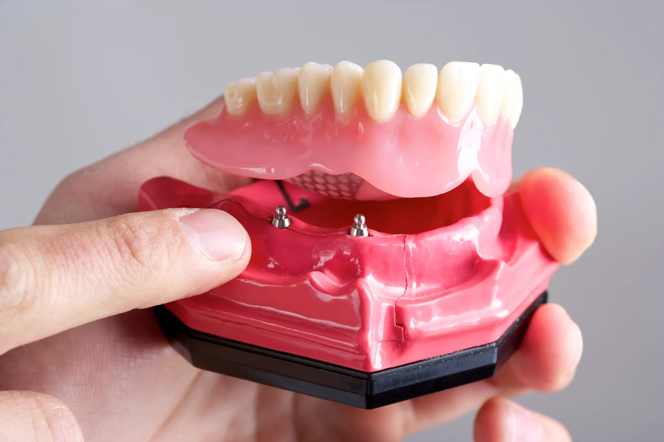 Hand pointing to model of All-on-4 implant denture
