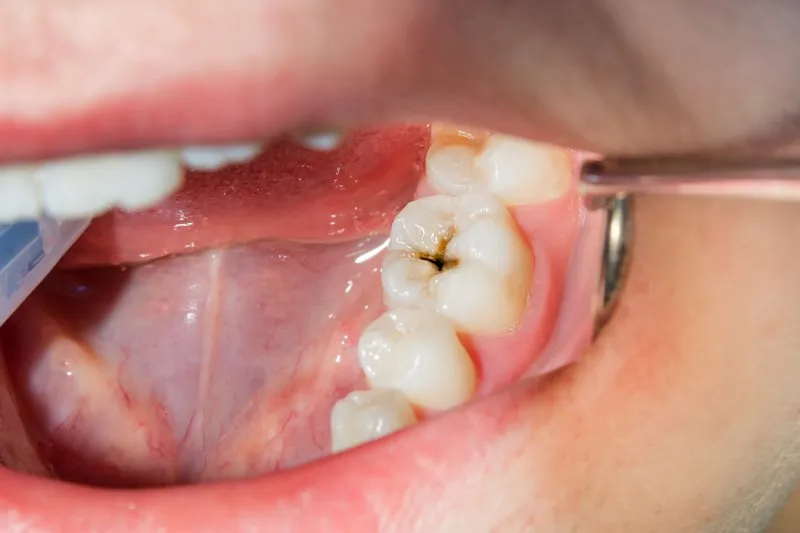 a tooth with a cavity