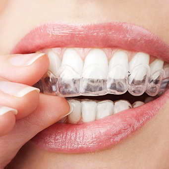 Understanding the Cost of Teeth Whitening